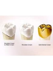 Dental Crowns - Simply Dental