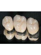 PFM Crown - Simply Dental