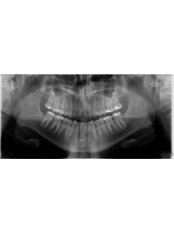 Digital Panoramic Dental X-Ray - Simply Dental
