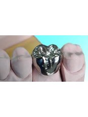 Stainless Steel Crown - Simply Dental