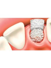 Bone Graft  - Solis Oral Care Center