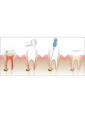 Root canals - Solis Oral Care Center