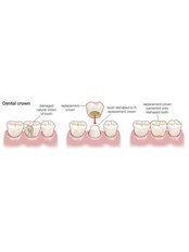 Dental Crowns - Solis Oral Care Center