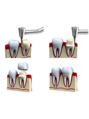 Dental Crowns - Solis Oral Care Center
