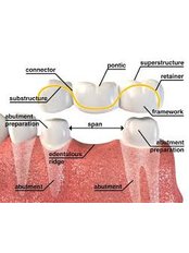 Dental Bridges - Solis Oral Care Center