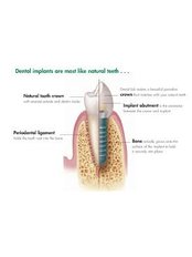 Dental Implants - Solis Oral Care Center