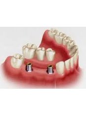 Implant Bridge - Solis Oral Care Center