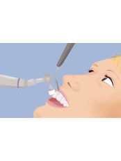Teeth Cleaning - Solis Oral Care Center