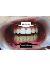 Teeth Whitening - Solis Oral Care Center