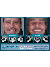 All-on-4 Same Day Teeth - SOTA DENTAL LOS ALGODONES