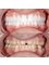 Supreme Dental Clinic - Full porcelain/Ceramic Crowns 