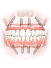 All-on-4 Dental Implants - The All on X Dental Studio