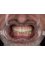 The Dental Corner - Full top zirconia over implants 