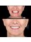 The Dental Corner - smile makeover with zirconia crowns 