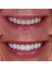 Zirconia Crown - Unik Specialized Dentistry