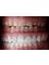 Unik Specialized Dentistry - Oral Rehabilitation, Zirconia Crowns. 