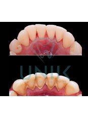 Teeth Cleaning - Unik Specialized Dentistry