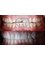 Unik Specialized Dentistry - Oral Rehabilitation, Zirconia Crowns. 