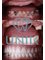 Unik Specialized Dentistry - Upper denture, zirconia crowns with lower partial. 
