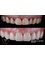 Vivant Smile Design - Before and after - crowns 