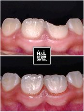 Chipped Tooth Repair - Clinica de Especialidades HyL Studio Dental