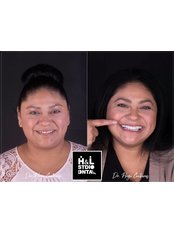Smile Makeover - Clinica de Especialidades HyL Studio Dental