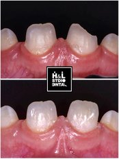 Chipped Tooth Repair - Clinica de Especialidades HyL Studio Dental