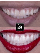 Porcelain Veneers - Clinica de Especialidades HyL Studio Dental