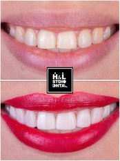 Hollywood Smile - Clinica de Especialidades HyL Studio Dental