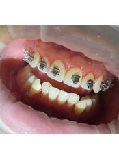 Self-ligating Braces - Clinica de Especialidades HyL Studio Dental