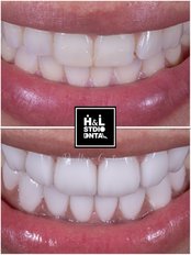 Hollywood Smile - Clinica de Especialidades HyL Studio Dental