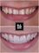 Clinica de Especialidades HyL Studio Dental - Before & After Full Mouth Veneers Shade BL4 
