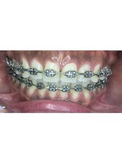 Metal Braces - Clinica de Especialidades HyL Studio Dental