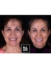 DSD - Digital Smile Design - Clinica de Especialidades HyL Studio Dental
