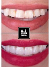 Veneers - Clinica Dental HyL Studio BRACES