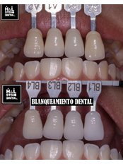 Teeth Whitening - Clinica Dental HyL Studio BRACES