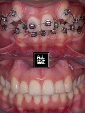 Orthodontics - Clinica Dental HyL Studio BRACES