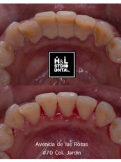 Teeth Cleaning - Clinica Dental HyL Studio BRACES