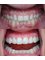 Dentallianz - Treatment: Crown lengthening & Dental veneers 