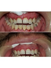 Teeth Cleaning - Goodental
