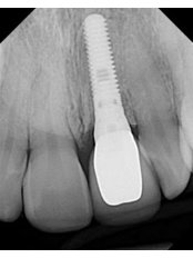 Immediate Implant Placement - Dental Implantology Unit at CMA Hospital