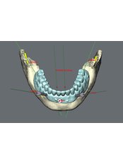 Restoration of Implants - Dental Implantology Unit at CMA Hospital