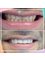 DentalHD Odontologia de Alta Estetica - composite veneers  