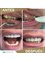 DentalHD Odontologia de Alta Estetica - Full Fix Porcelain restoration  