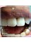 DentalHD Odontologia de Alta Estetica - Only one of them is a porcelain crown  