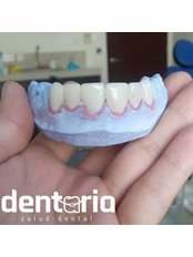 Dental Crowns. Zirconia or Emax. (CAD/CAM Dental Restorations) - Dentaria