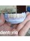 Dentaria - Veneers before cementation 