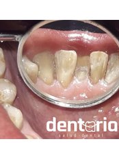 Prophilaxis / deep cleaning (Bad Breath Treatment) - Dentaria