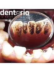 Prophilaxis / deep cleaning (Bad Breath Treatment) - Dentaria