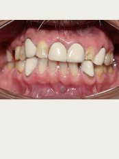Grupo Interdisciplinario Odontológico - Before Orthodontic treatment and Oral Rehabilitation